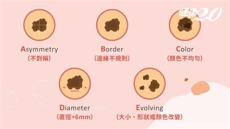 腳背黑斑|別把癌當痣！5部位冒黑點恐是惡性黑色素瘤 台大醫師。